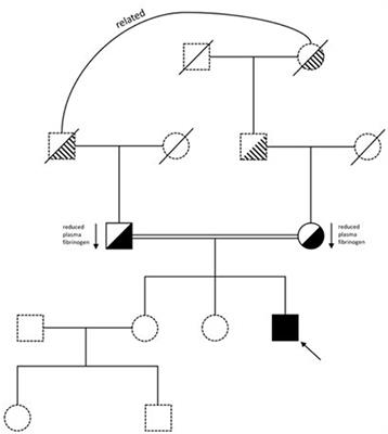 Are all fibrinogen concentrates the same? The effects of two fibrinogen therapies in an afibrinogenemic patient and in a fibrinogen deficient plasma model. A clinical and laboratory case report